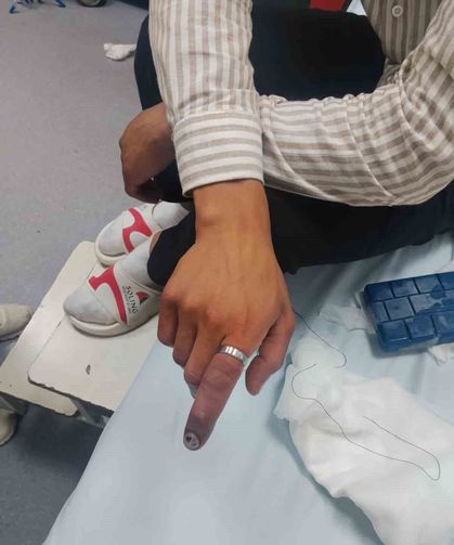 Parmağına sıkışan yüzük itfaiye ekiplerince kesilerek çıkarıldı